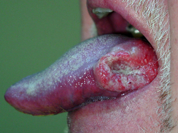 3 oral cancer