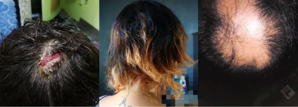 3 People Suffer Hair Damage After Using Cheap Diy Hair Treatments