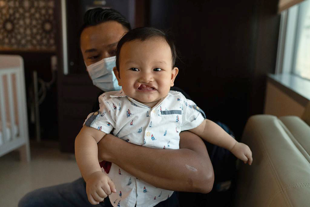 cleft lip and palate before and after operation smile