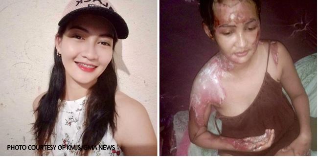 Pinay Suffers 2nd Degree Burn From Livein Partner The Filipino Times